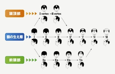 ハミルトン・ノーウッド分類に見る薄毛の進行度