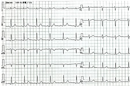 心電図検査