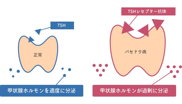 バセドウ病とは