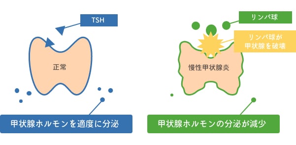 橋本病（慢性甲状腺炎）