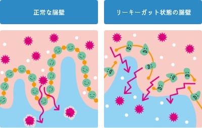 リーキーガット症候群